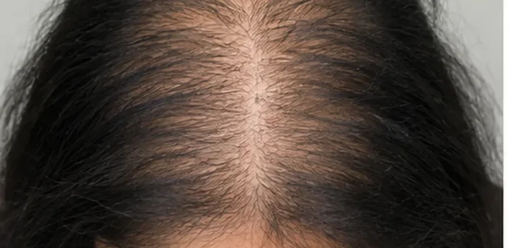 Central part widening in female pattern hair loss