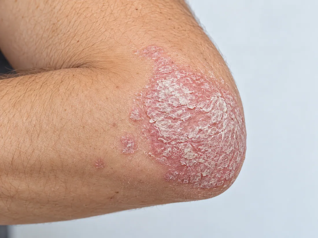 Clinical illustration of plaque psoriasis
