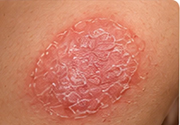 AI-generated photorealistic example of a round nummular eczema plaque on an arm