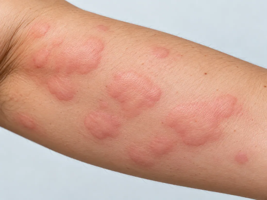 Clinical illustration of urticarial wheals