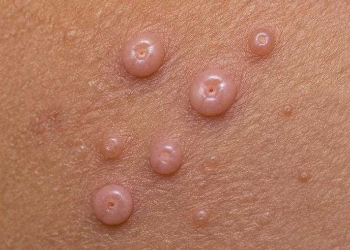 AI-generated clinical close-up of pearly molluscum-like papules with central dimples