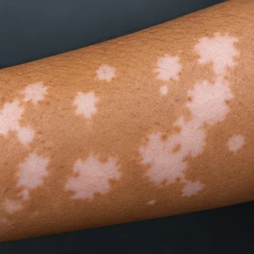Close-up AI-generated illustration of vitiligo on a forearm