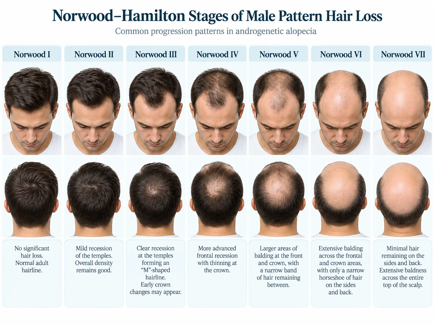 Norwood–Hamilton stages of male pattern hair loss showing progression from stage I to stage VII