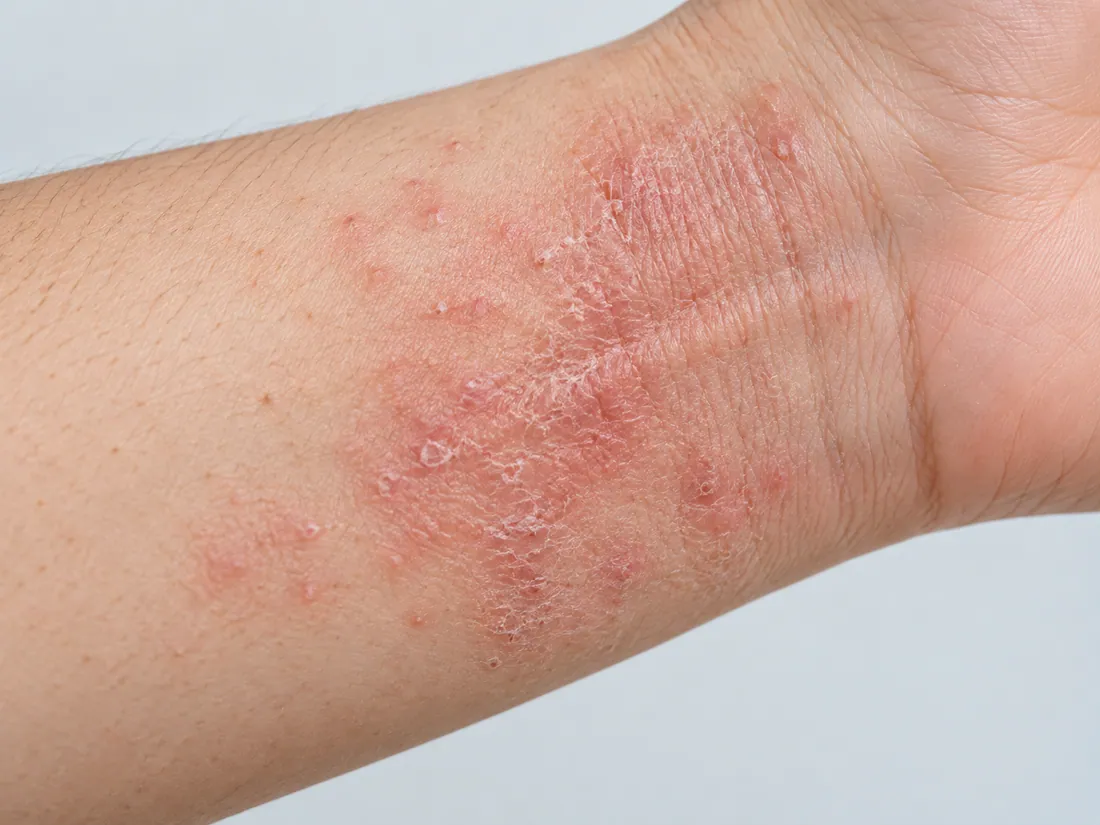 Clinical illustration of eczema on the wrist