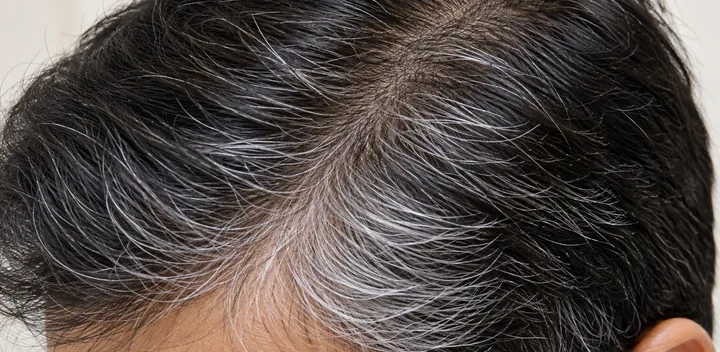 Premature greying showing white hairs mixed with dark scalp hair