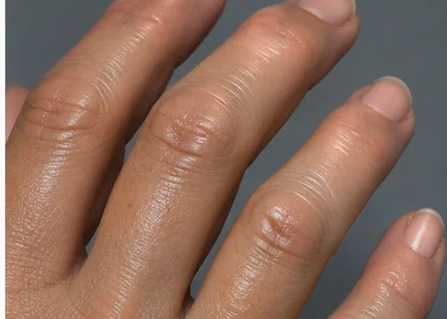 AI-generated clinical close-up of tight shiny skin on fingers suggestive of sclerodactyly