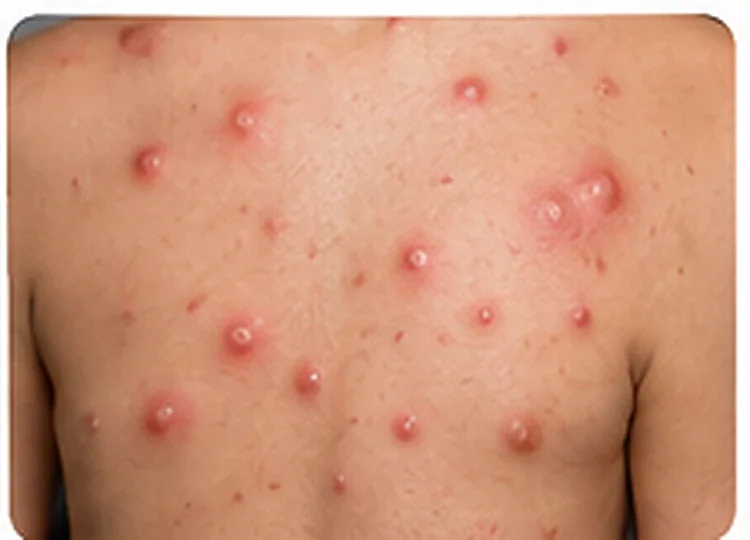 AI-generated educational clinical image illustrating Varicella (Chickenpox)