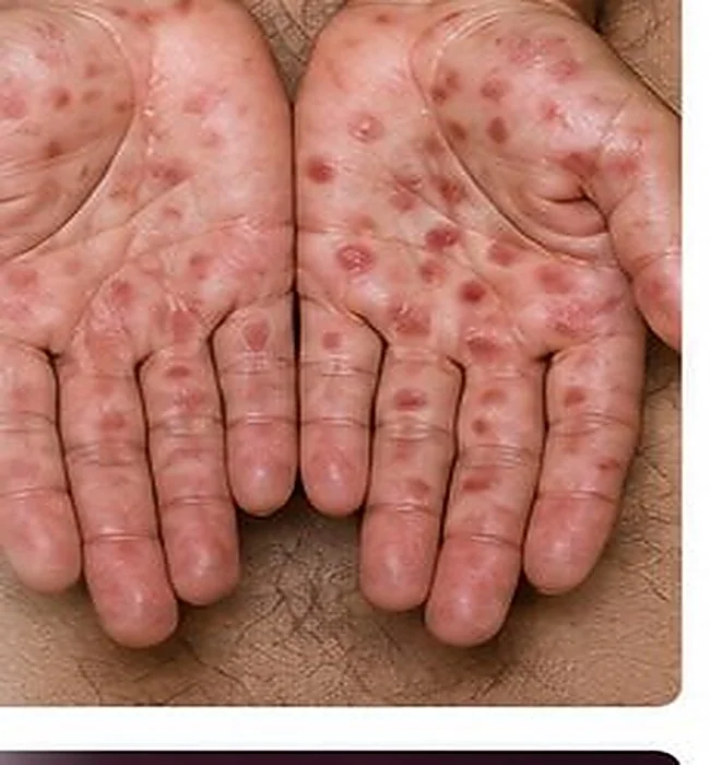 Illustrative palmar rash that may occur with secondary syphilis — AI-generated medical illustration, not an actual patient photograph