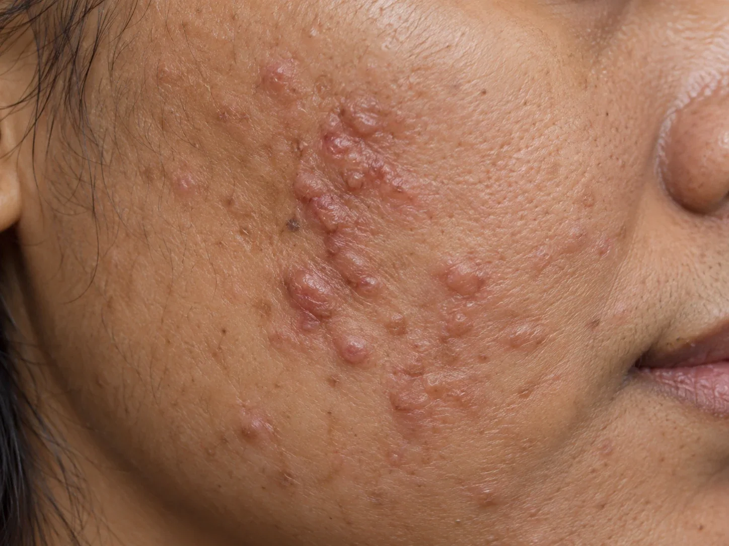 Clinical-style close-up of raised acne scars on the cheek