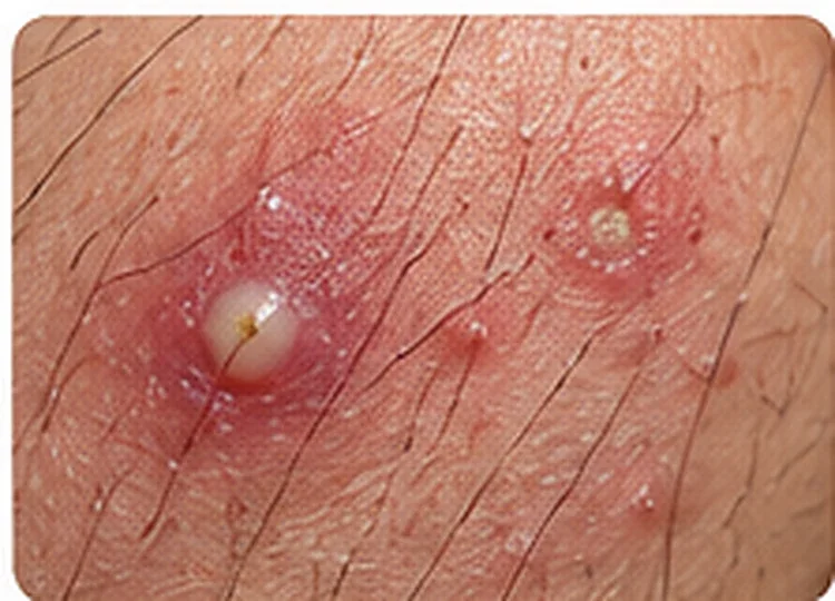 AI-generated educational clinical image illustrating Folliculitis & Bacterial Skin Infections