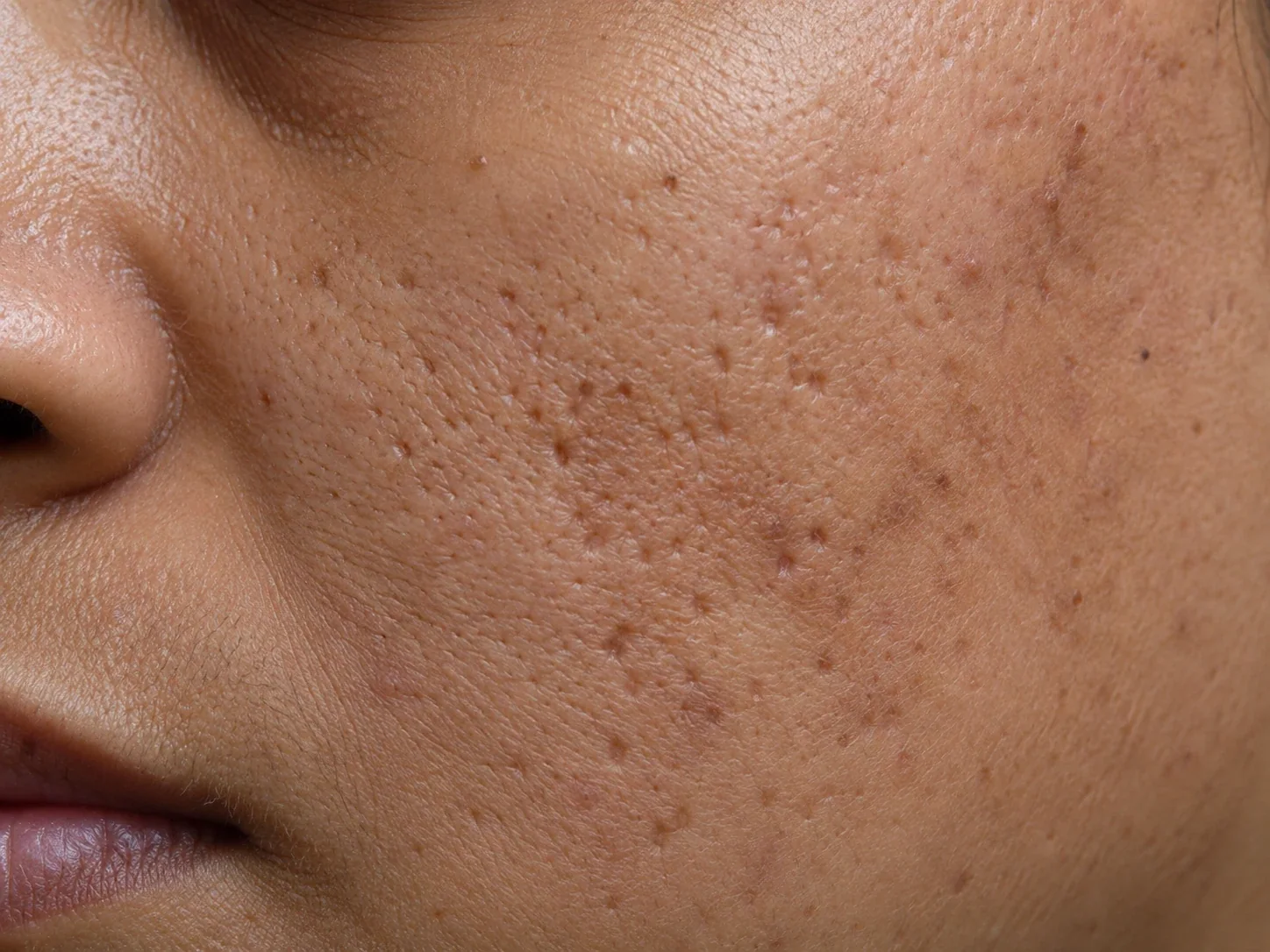 Clinical-style close-up of ice-pick acne scars on the cheek