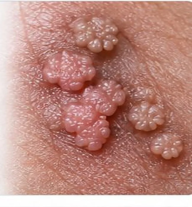 Wart-like raised bumps on non-genital skin — AI-generated medical illustration, not an actual patient photograph