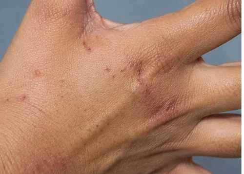 AI-generated clinical close-up of scabies-like papules and scratching marks around fingers