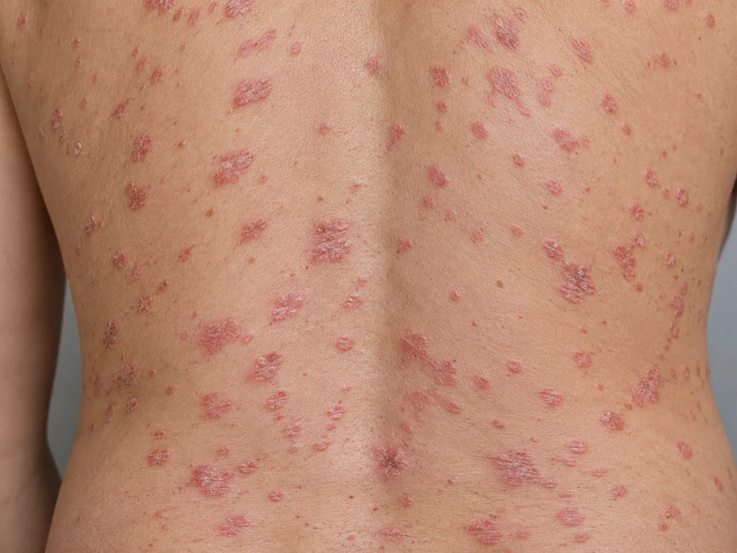 AI illustration of guttate psoriasis with small red spots