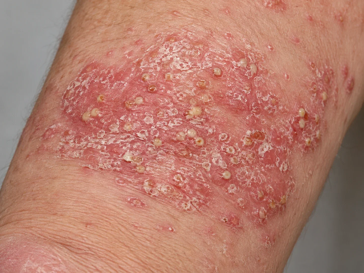 AI illustration of pustular psoriasis with inflamed skin