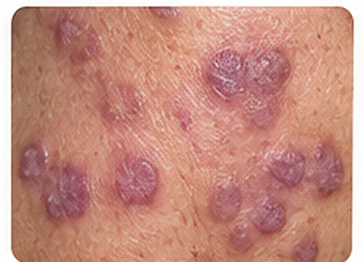 AI-generated educational clinical image illustrating Lichen Planus