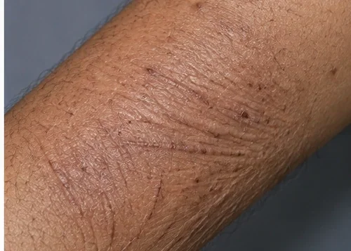 AI-generated close-up of chronically scratched and thickened skin on a forearm