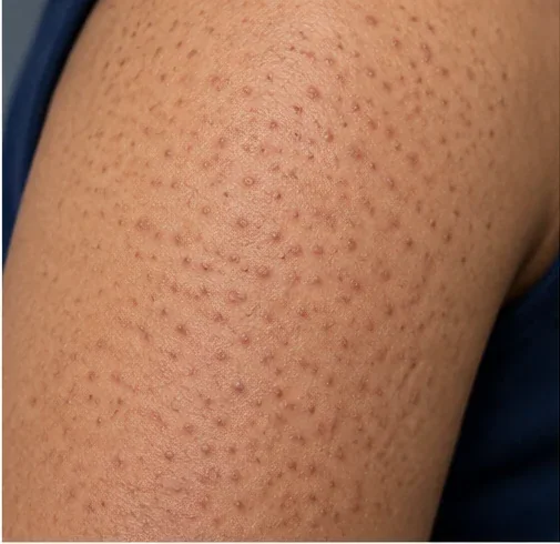 AI-generated educational clinical image illustrating Keratosis Pilaris (Chicken Skin)