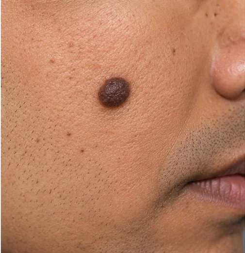 AI-generated educational clinical image illustrating Moles (Nevi) & Mole Removal