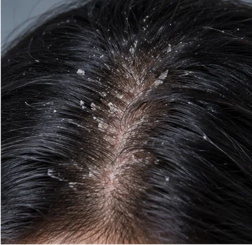 AI-generated educational clinical image illustrating Seborrhoeic Dermatitis / Dandruff