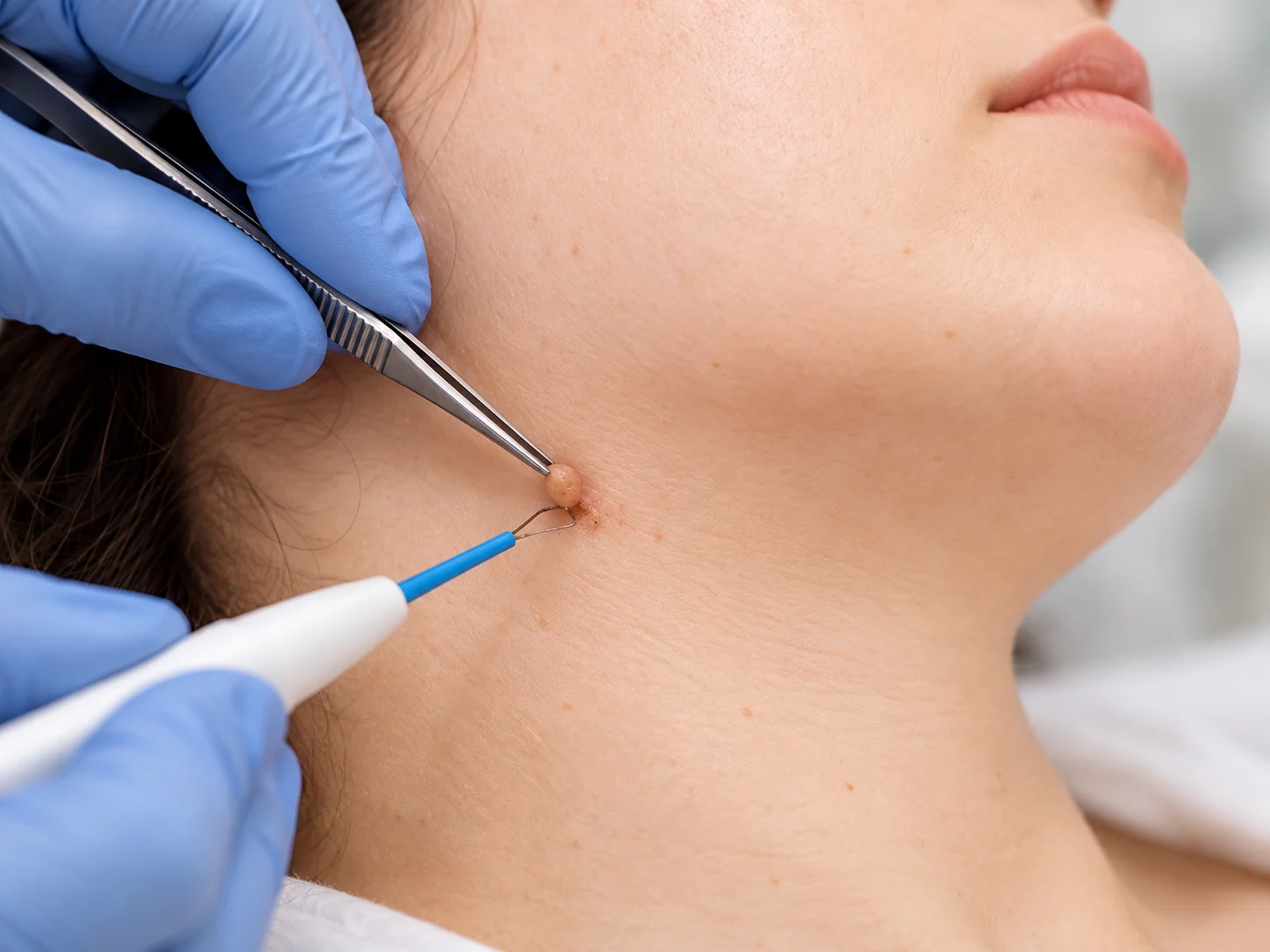 AI-generated clinical close-up of radiofrequency removal of a small skin tag on the neck