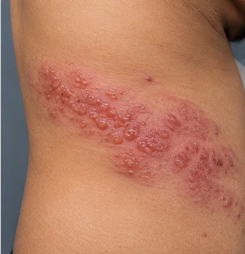 AI-generated educational clinical image illustrating Herpes Zoster (Shingles)