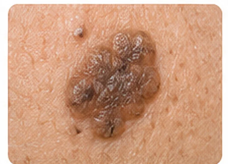 AI-generated educational clinical image illustrating Seborrhoeic Keratosis (Benign Age Spots)