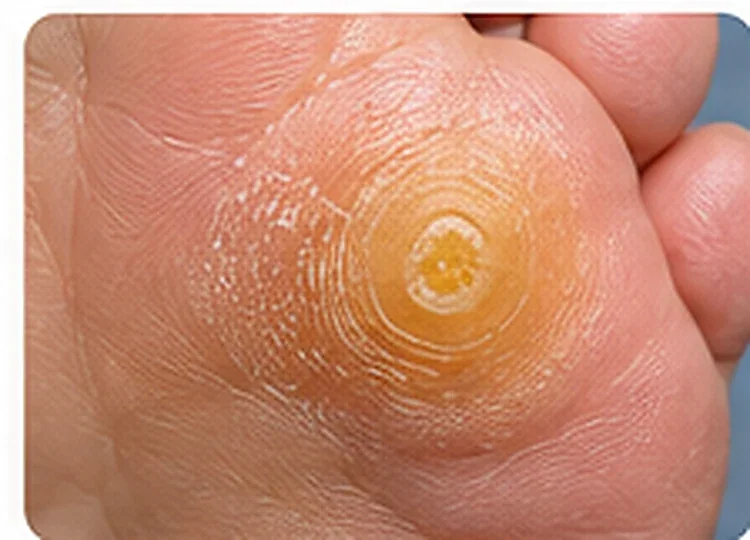 AI-generated educational clinical image illustrating Corns & Calluses (Hard Skin on Feet)