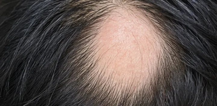 A smooth round patch of alopecia areata on the scalp