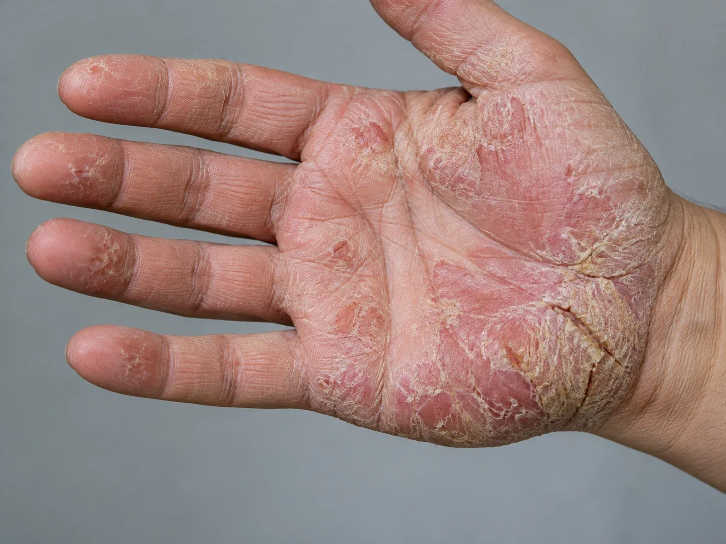 AI illustration of scaly palmoplantar psoriasis on a hand