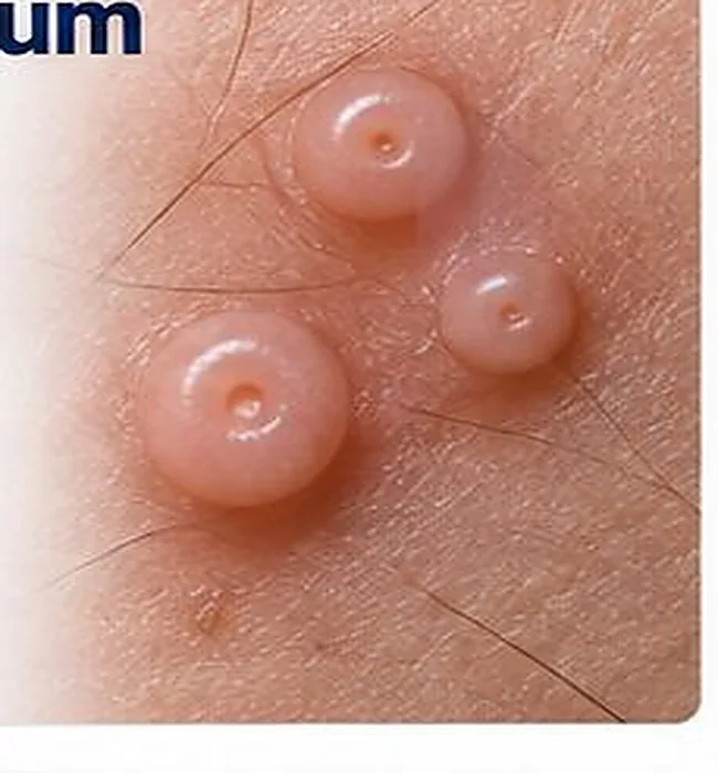 Smooth skin-coloured papules with central dimpling — AI-generated medical illustration, not an actual patient photograph
