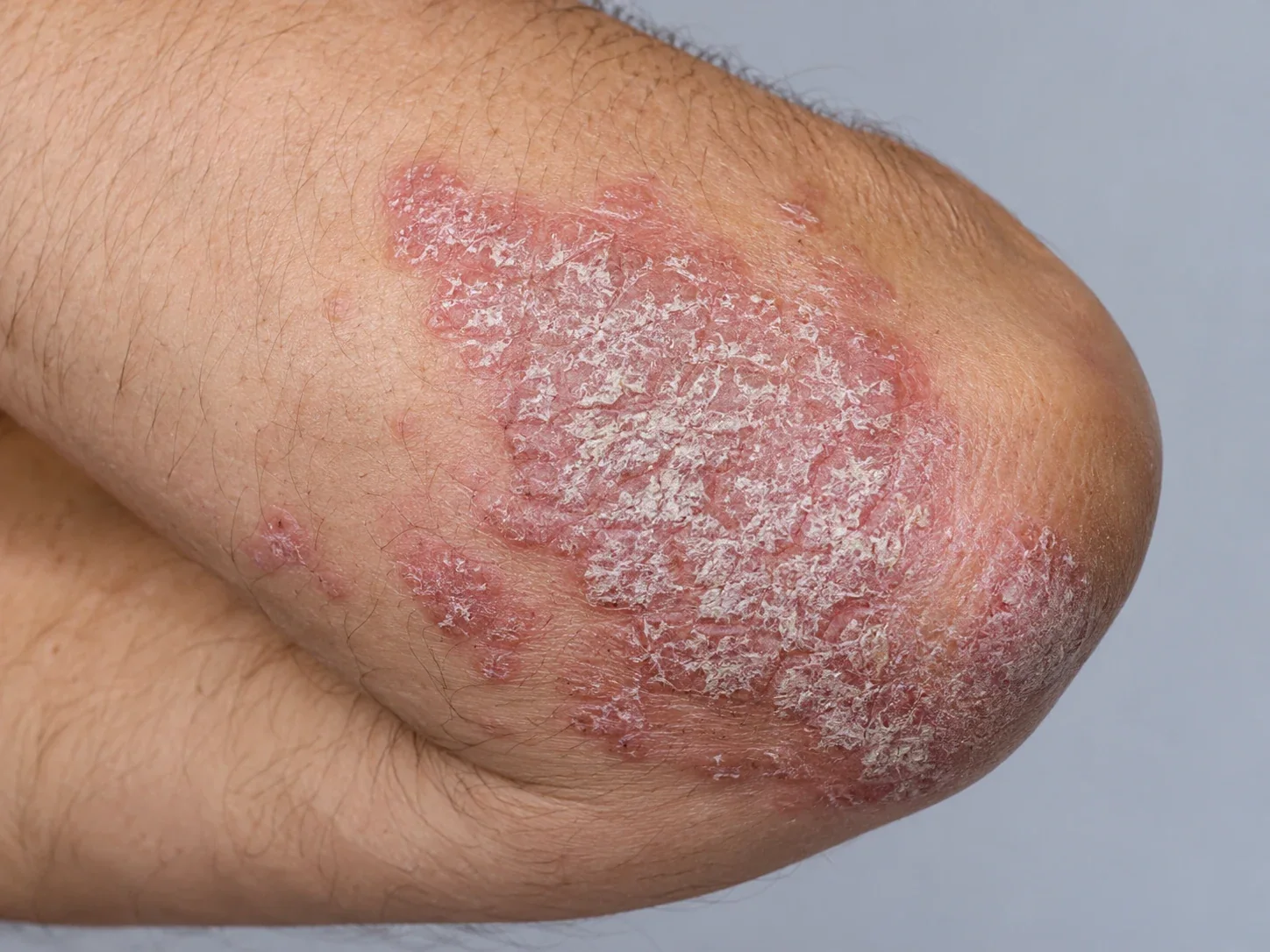 A photorealistic AI illustration of plaque psoriasis on an arm
